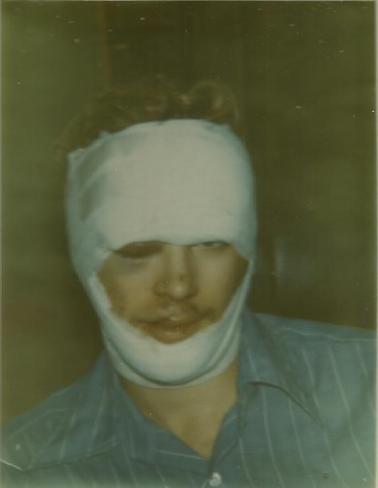 Jay's accident picture 1974